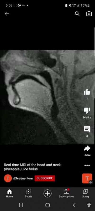 Curious what settings produce such a strong visual contrast between the pineapple juice and the rest of the person's tissues