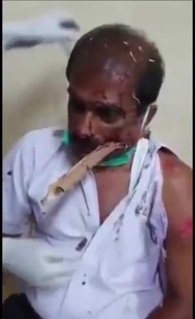 Aftermath of taking a branch through the face.