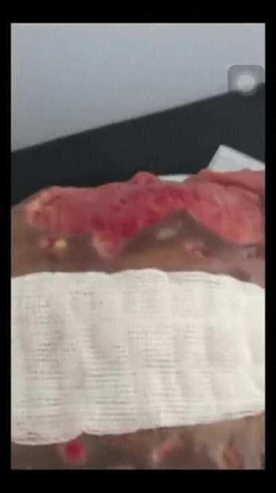 Butt implants gone wrong [nsfw]