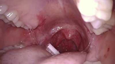 The swallowing part from my previous post nwn (Whole wired earphones ^^🎵)