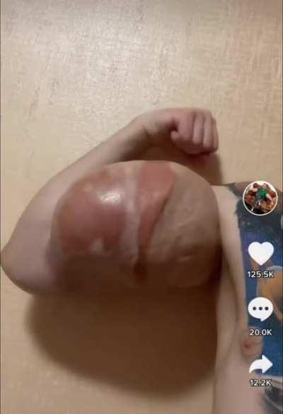 A synthol bicep [NSFW]
