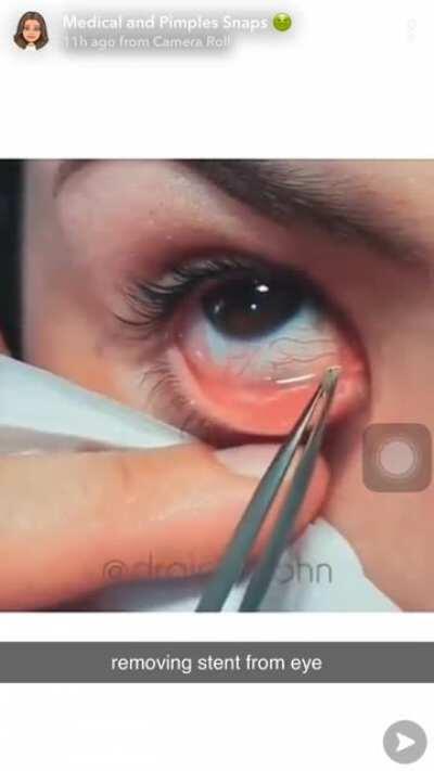 Why does my eye hurt after watching this?