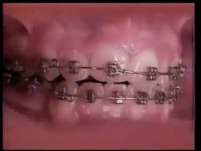 Braces moving teeth in under 30 seconds