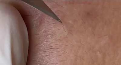 Temple blackheads