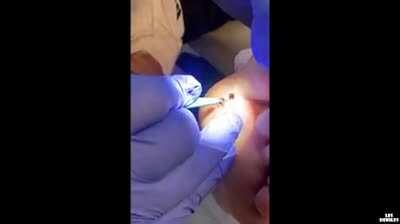 A splinter that hurt