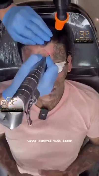 Facial Laser Tattoo Removal 