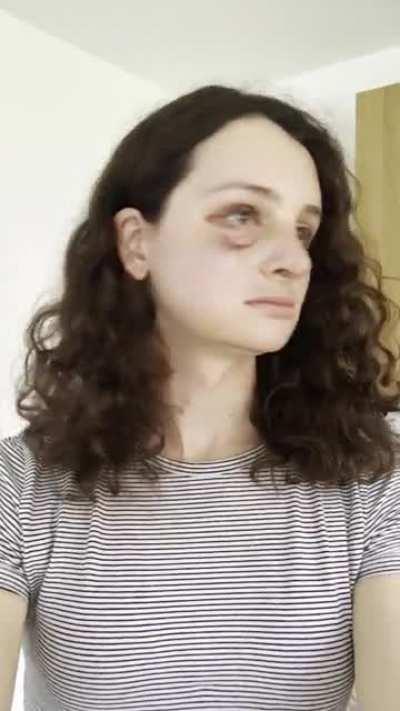 June to 1 week post op, 1 month, 5months, facial team FFS brow, nose, jaw