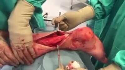 Assessing the Achilles’ tendon: the calf squeeze or Thompson test provides an accurate means for detecting complete Achilles tendon rupture