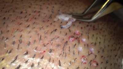 Hair Transplant Follicular Unit Extraction
