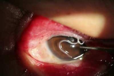 A 34-year-old man reported the sensation of a foreign body and itching in his right eye. Examination showed two worms beneath the upper eyelid.