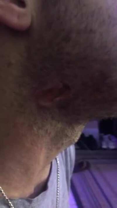 My buddy got shot in the neck and face with a 9mm almost point-blank, this is 9 days later (he has to plug his neck hole when he drinks)