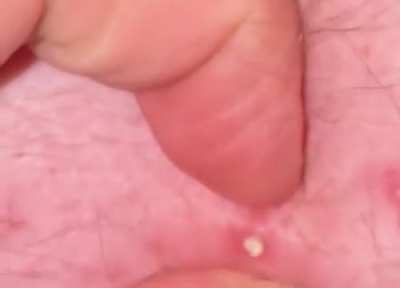 Quick pop on my husbands back, small amount of blood