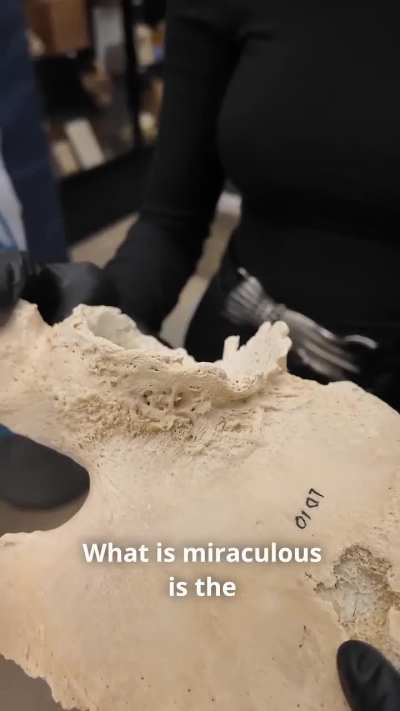 Exploring pelvic eburnation