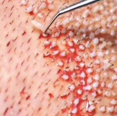 Getting a hair transplant