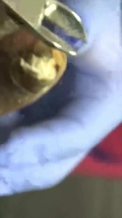 This man's giant toenail 