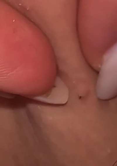Just found this video of a blackhead I had