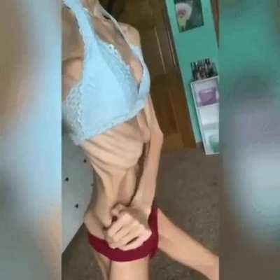 Extreme weightloss in woman with Anorexia