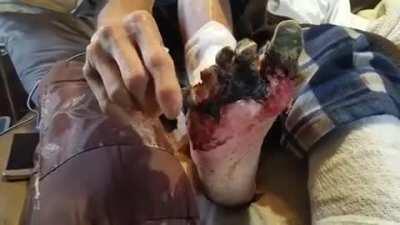 Old man carelessly yanks off his pinky toe