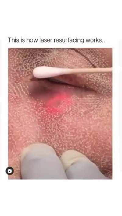 Лазерная подтяжка