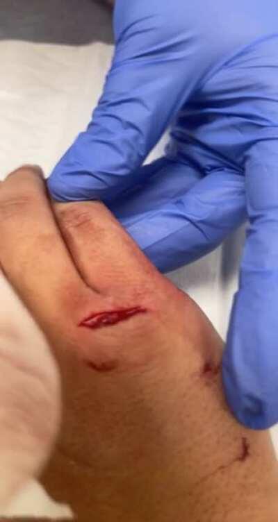 Sliced down to the knuckle bone, luckily the tendon wasn’t cut