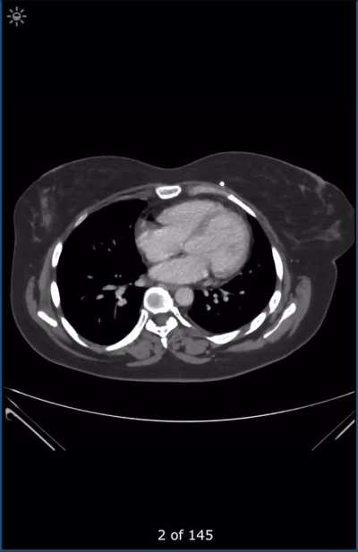 Question: are CTs accurate in diagnosing a unicornuate uterus?