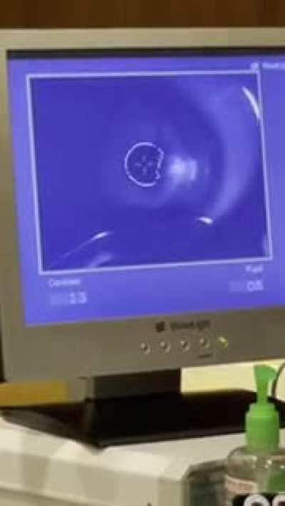 in case you’ve ever wondered how lasik works