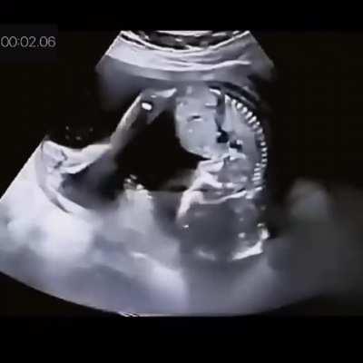 It looks like the fetus is throwing a temper tantrum