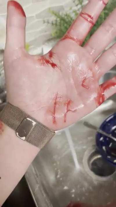 Got a cat bite and earned myself the rabies vaccines