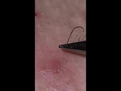 Deep extractions. The skin won't heal cleanly with these hiding