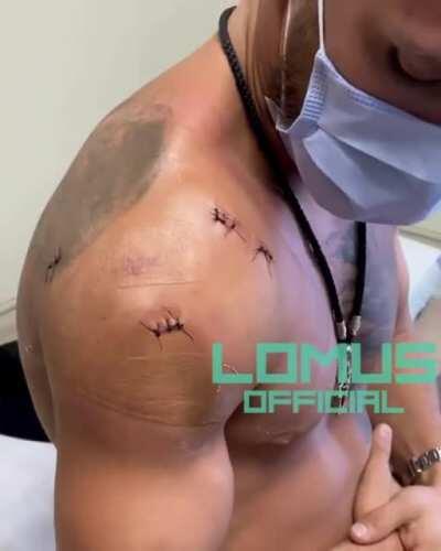 Photos and videos of Vasiliy Lomachenko recovering from shoulder surgery have been released.