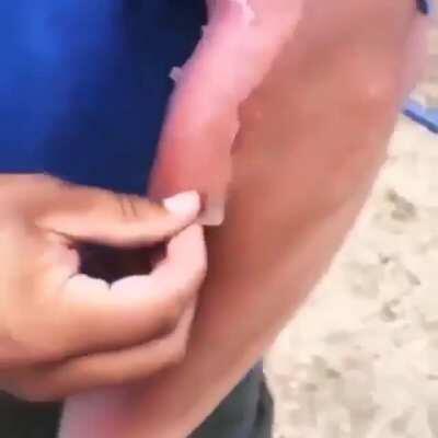 What did michael jackson when postoperative