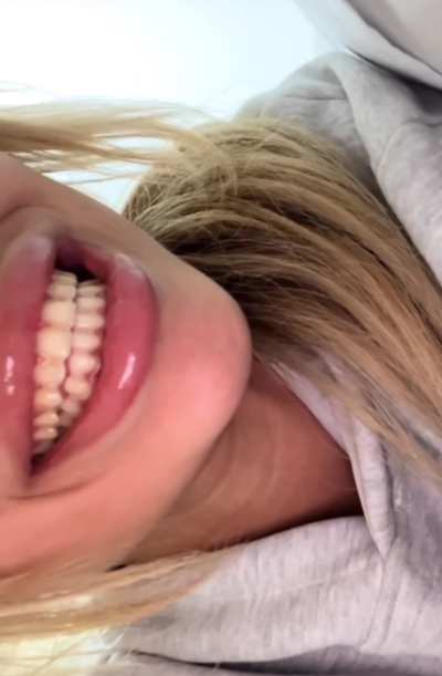 Veneer journey in under 30 seconds