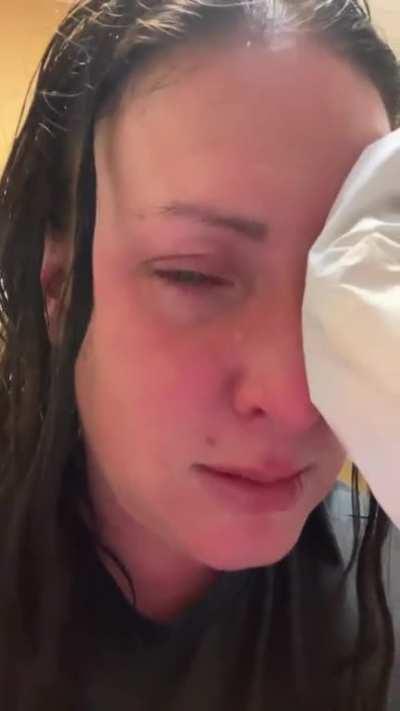 Girl mistakes superglue for eye drops