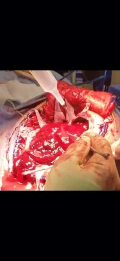 Evacuation of subdural hematoma.