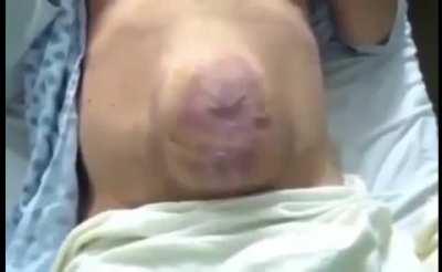 A giant abdominal hernia