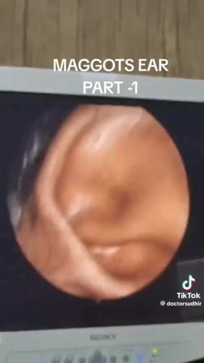 Translation of the voice over: The child was having ear pain from a couple days and they brought him to the ear specialist upon checking on worms in his ear. It would have to go through a couple of these sessions to get rid of them.