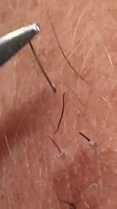 Forearm Mole Strikes Again