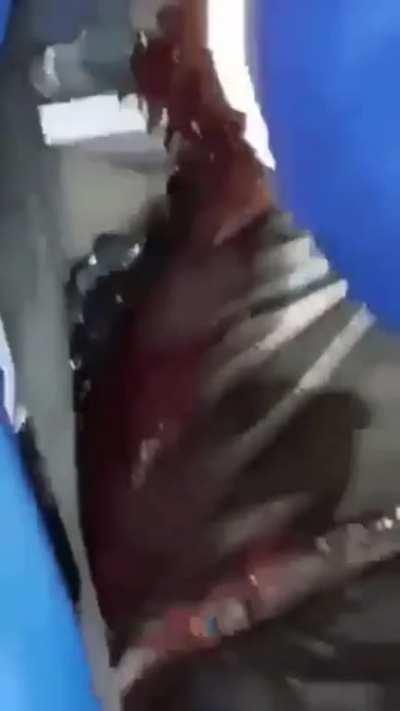 Man still breathing with face blown off after a failed suicide attempt