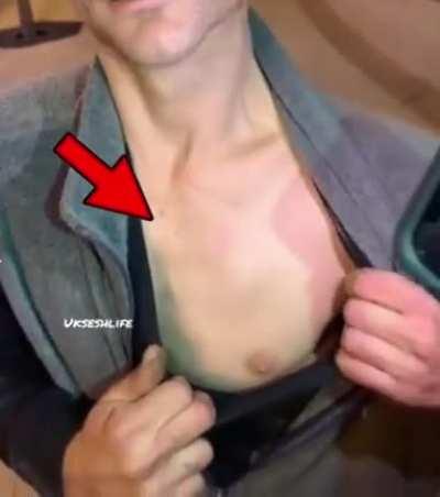 Man with Ectopia cordis