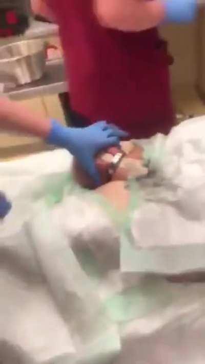 Man go into surgery because of the excessive use of cock ring