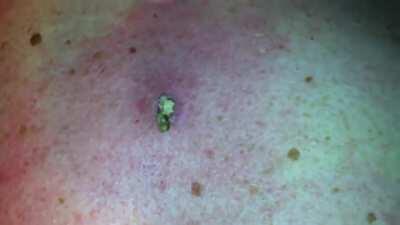 10 year old massive nasty blackhead cyst finally bursts