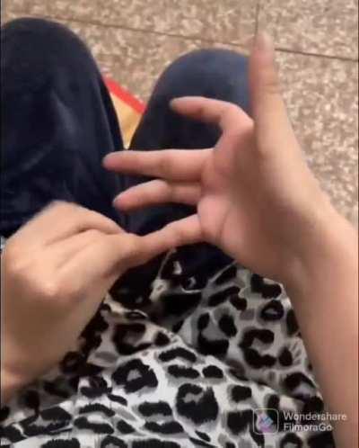 This guy was born with removable fingers