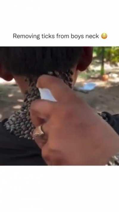 Ticks cover boys neck (stolen from IG)