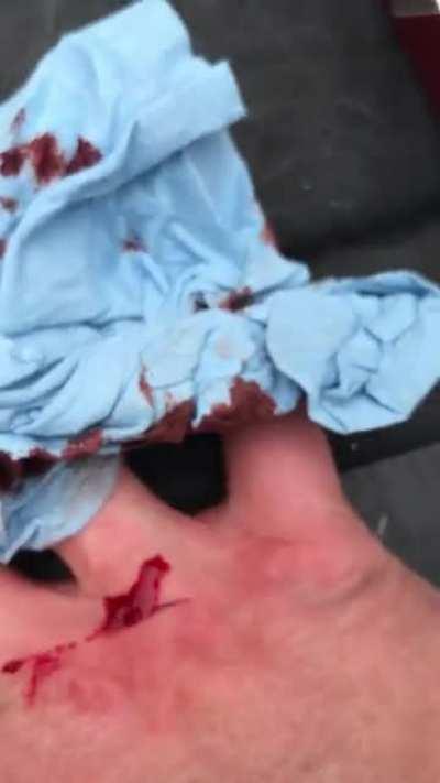 Guess the mower blades are sharp…. (blood)