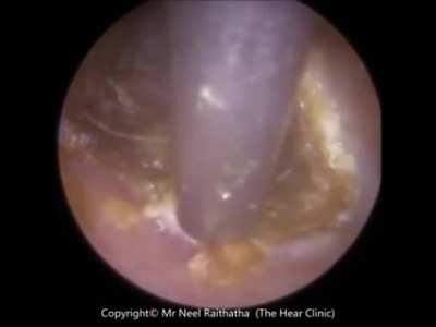 Years of EARWAX Buildup Results In This