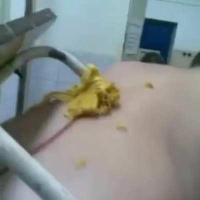 HMFT after I fall on an upside down stool