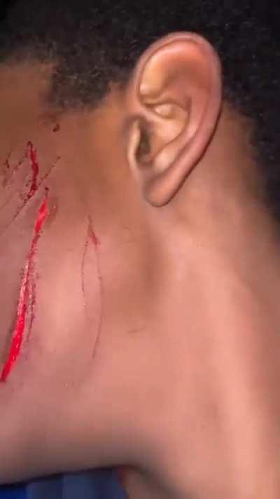 Aftermath of Dagneham yutes slicing a guys face for running off with their drugs 