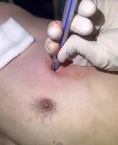 Chest seal and its consequences + the thoracostomy mom said we have at home