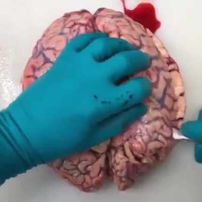 Intracerebral hemorrhage