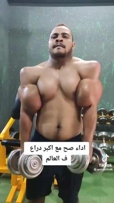 This guy's appearance after Synthol Injections